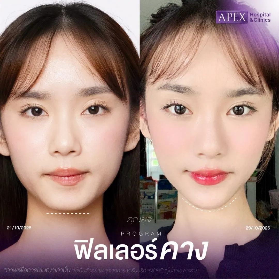 รีวิวฉีดฟิลเลอร์คาง