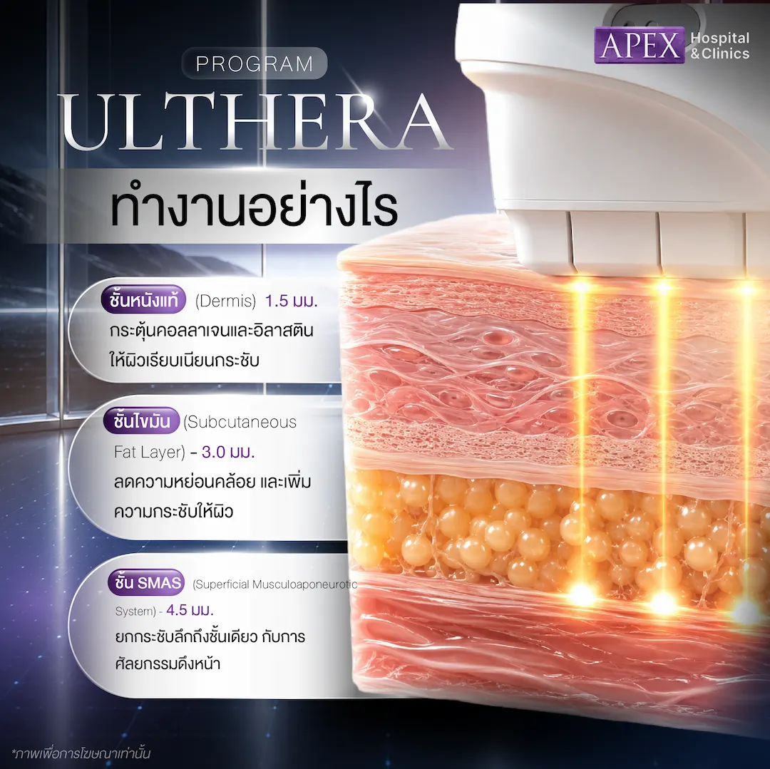 เครื่อง Ulthera ทำงานอย่างไร