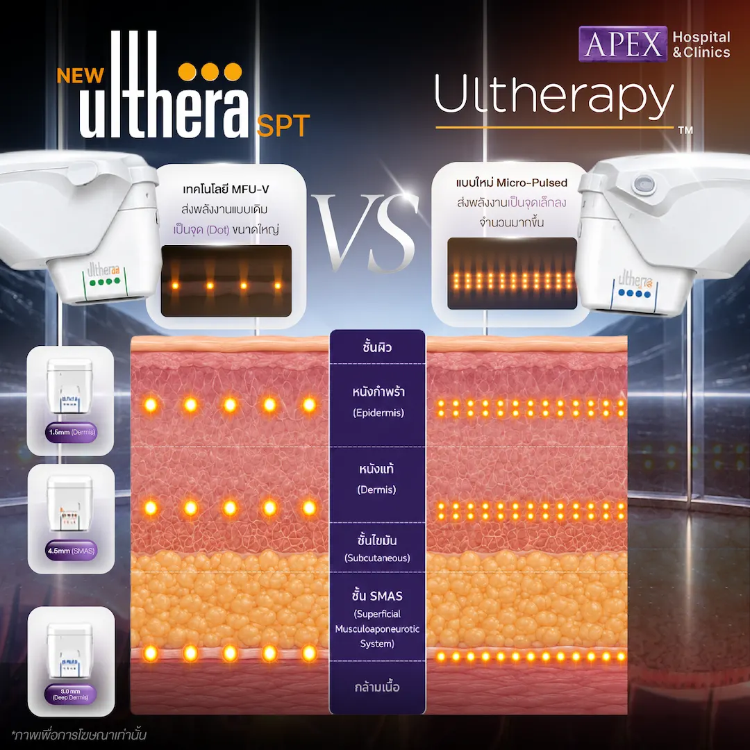 เครื่อง Ulthera มีรุ่นไหนบ้าง