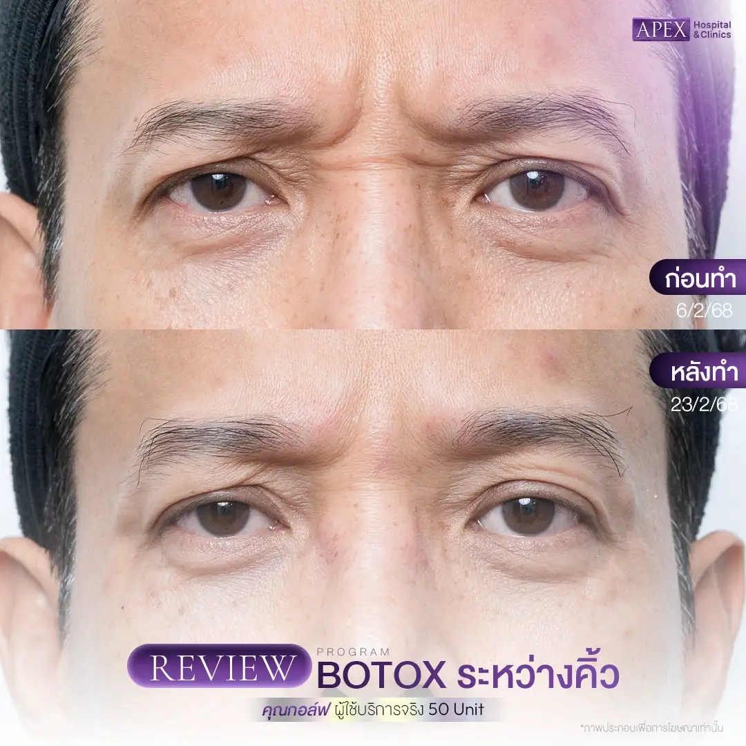 Botox เคสที่ 1 ริ้วรอยหว่างคิ้วและหน้าผาก