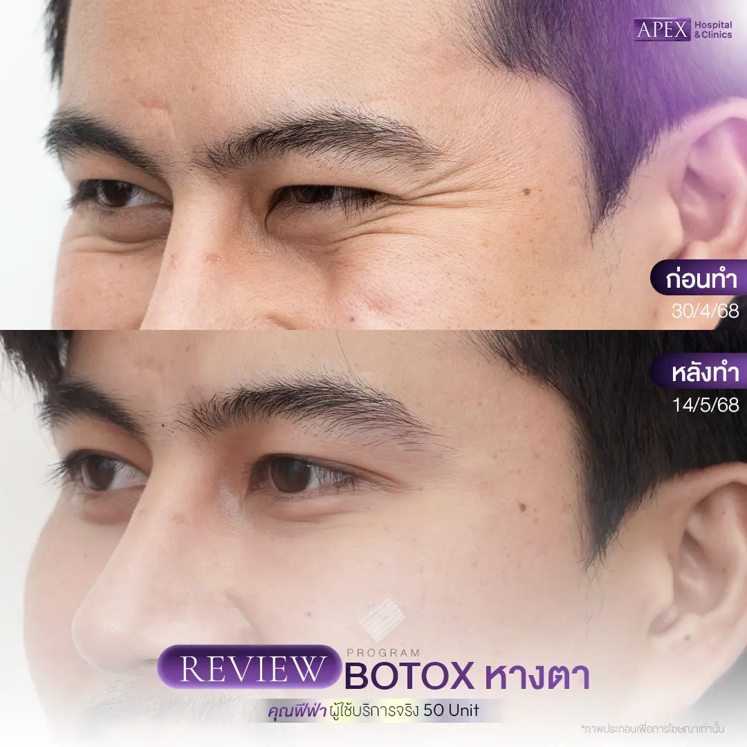 Botox เคสที่ 2 รอยหางตาเวลายิ้ม