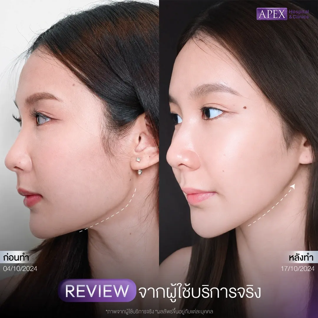 Botox เคสที่ 3 กรามเด่นจากกล้ามเนื้อ