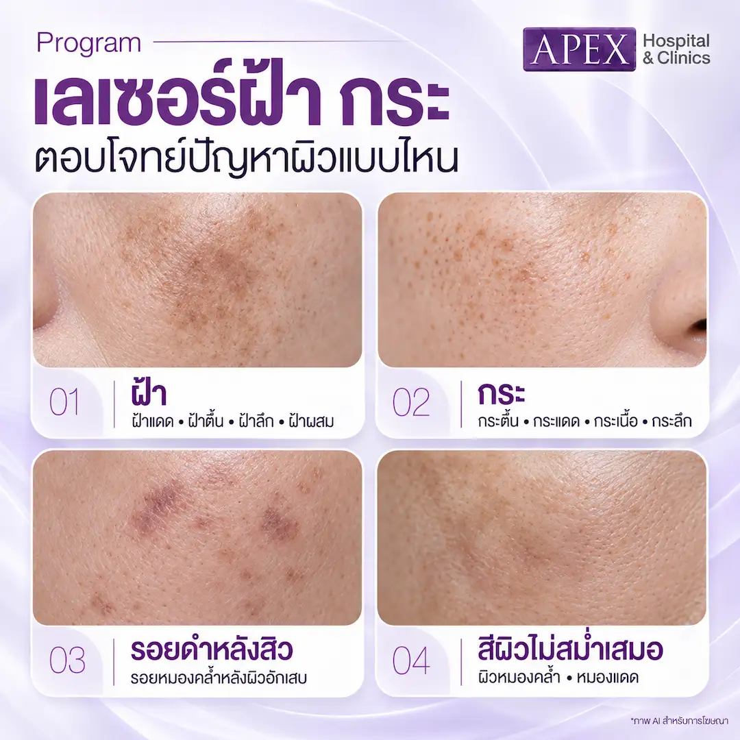 เลเซอร์ฝ้า กระ ตอบโจทย์ปัญหาผิวแบบไหน