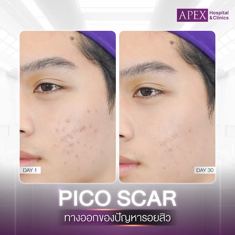 เลเซอร์รอยสิว รีวิว