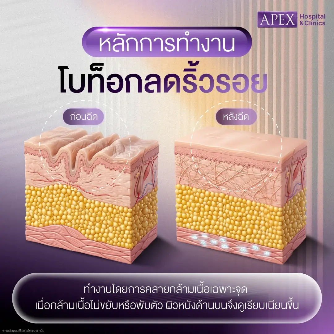 โบท็อกลดริ้วรอย ทำงานอย่างไร