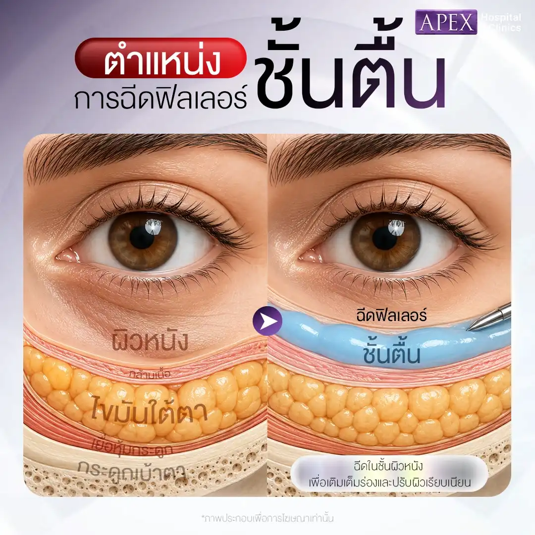 ใต้ตาชั้นตื้น (Superficial Layer)
