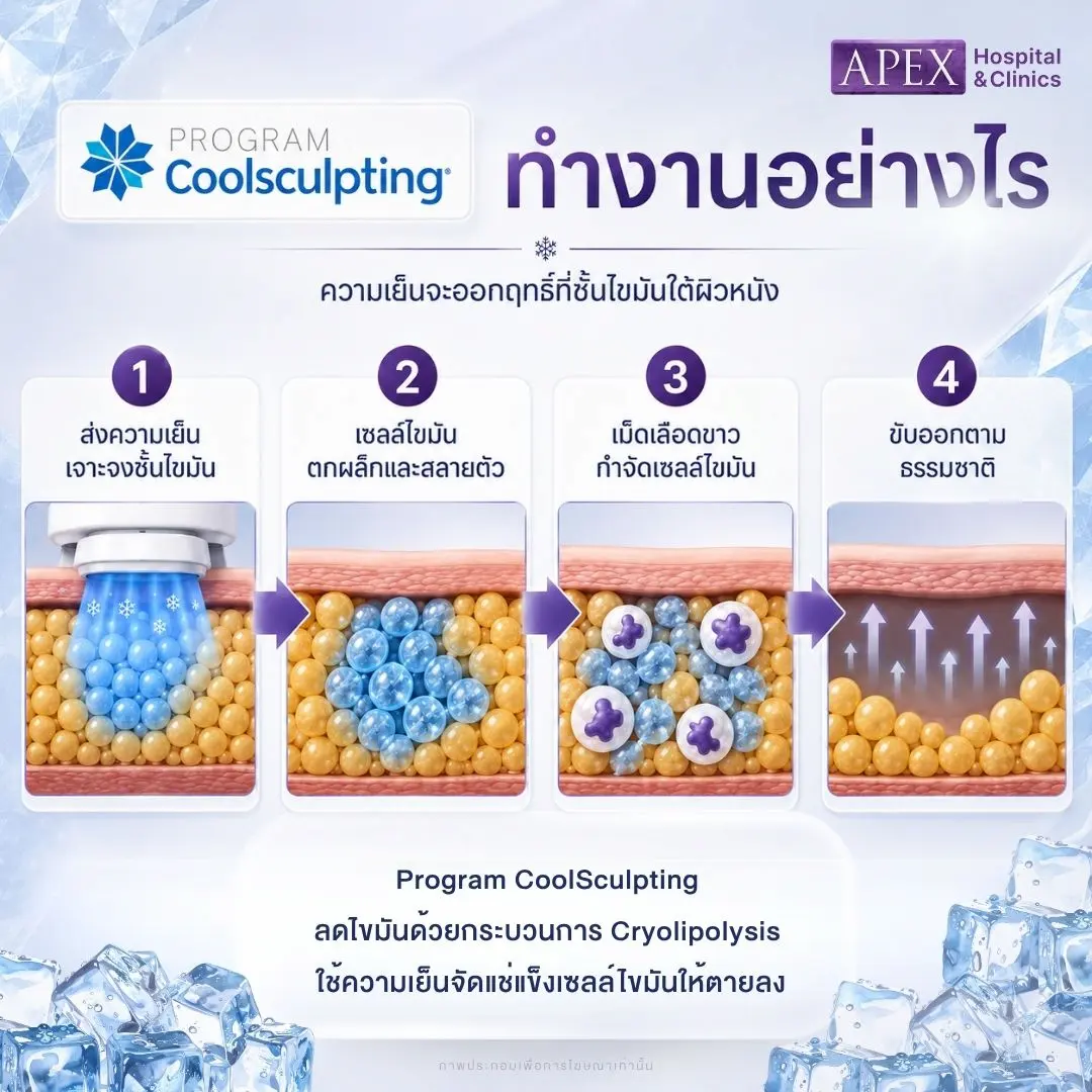 Coolsculpting ทำงานอย่างไร