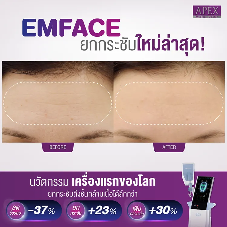 Emface รีวิว
