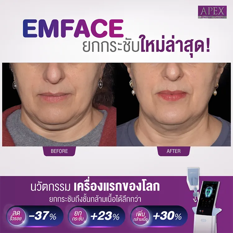Emface รีวิว