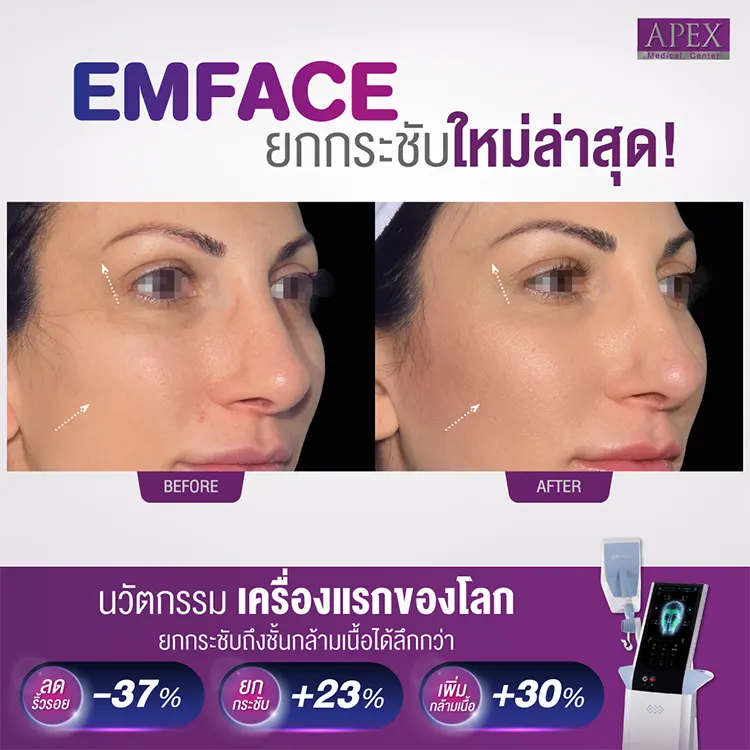 Emface รีวิว