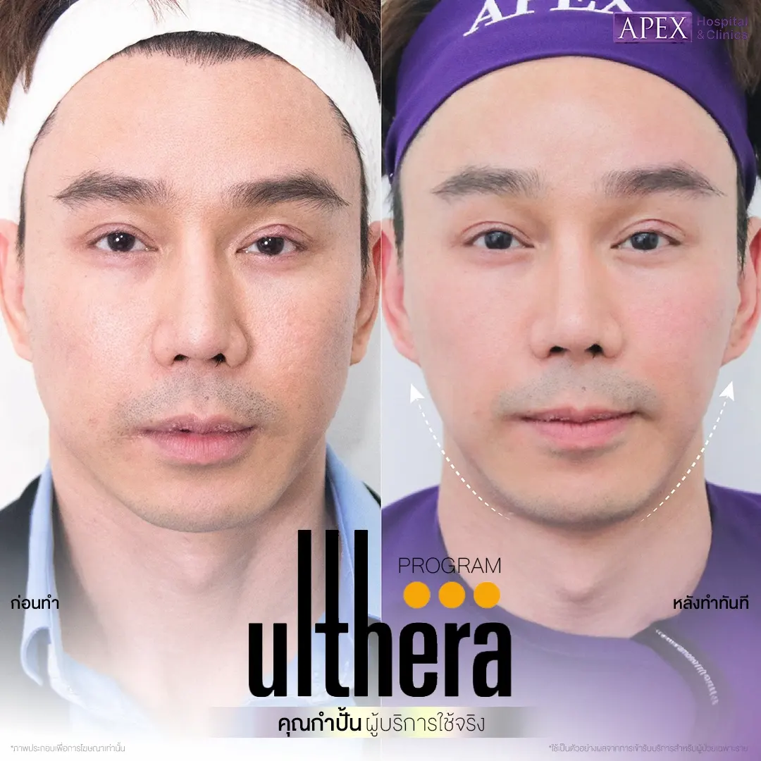 รีวิวทำ HIFU Apex Clinic