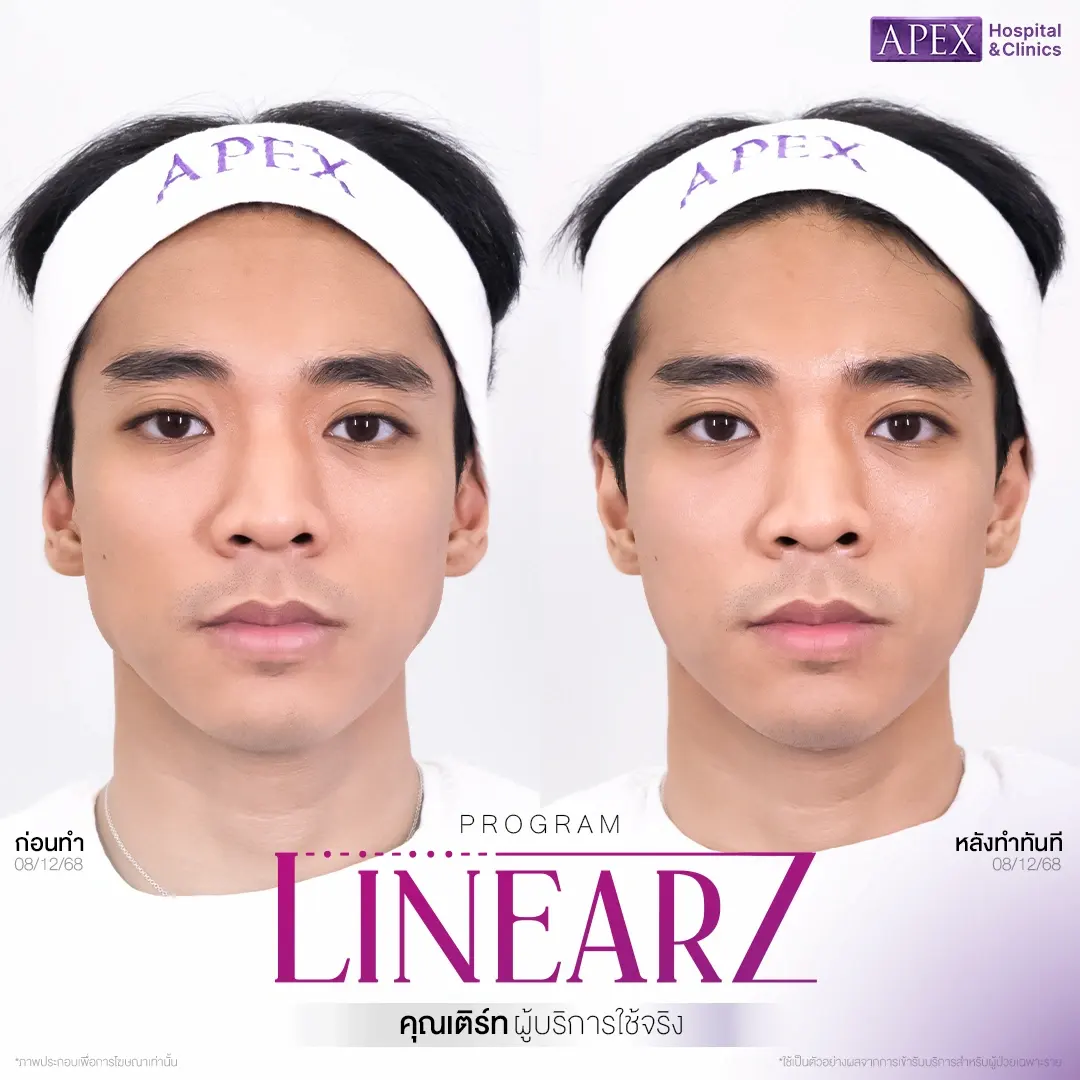 รีวิวทำ HIFU Apex Clinic
