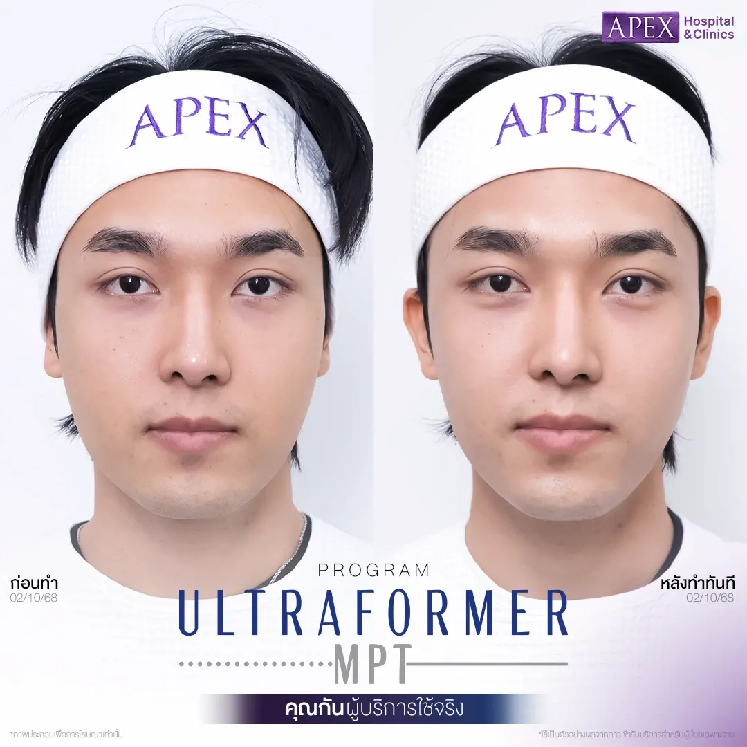 รีวิวทำ HIFU Apex Clinic