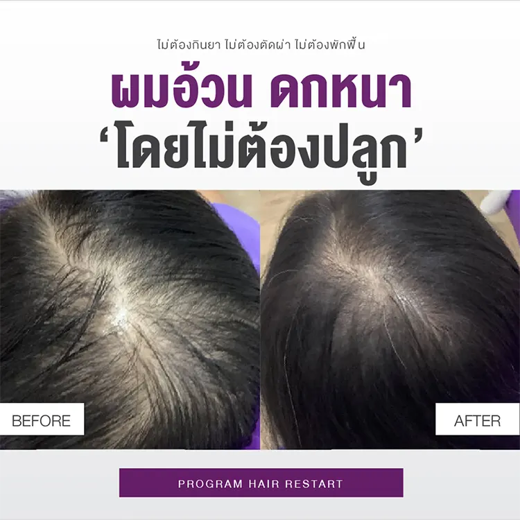 Hair Restart รีวิว