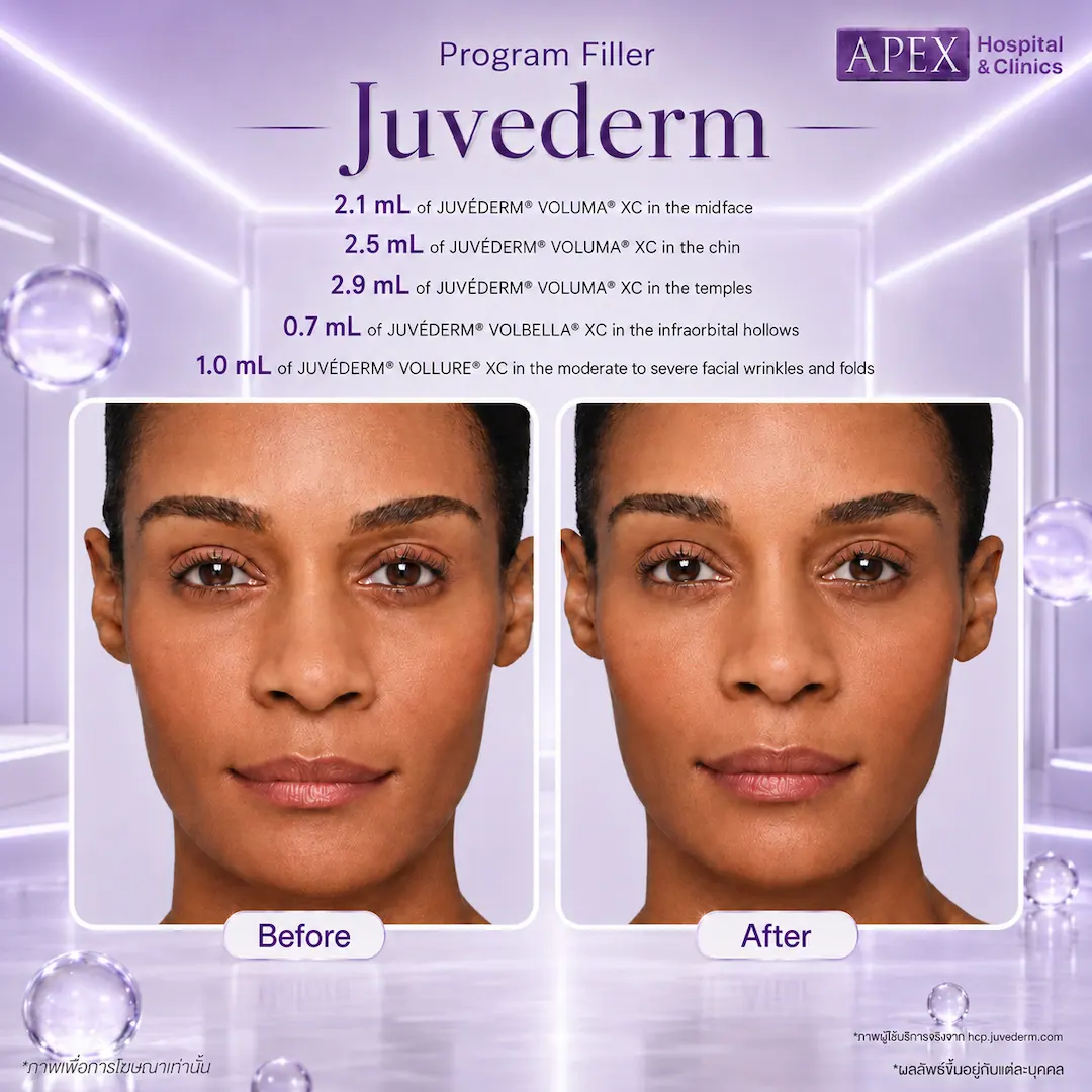 รีวิว ฟิลเลอร์ Juvederm