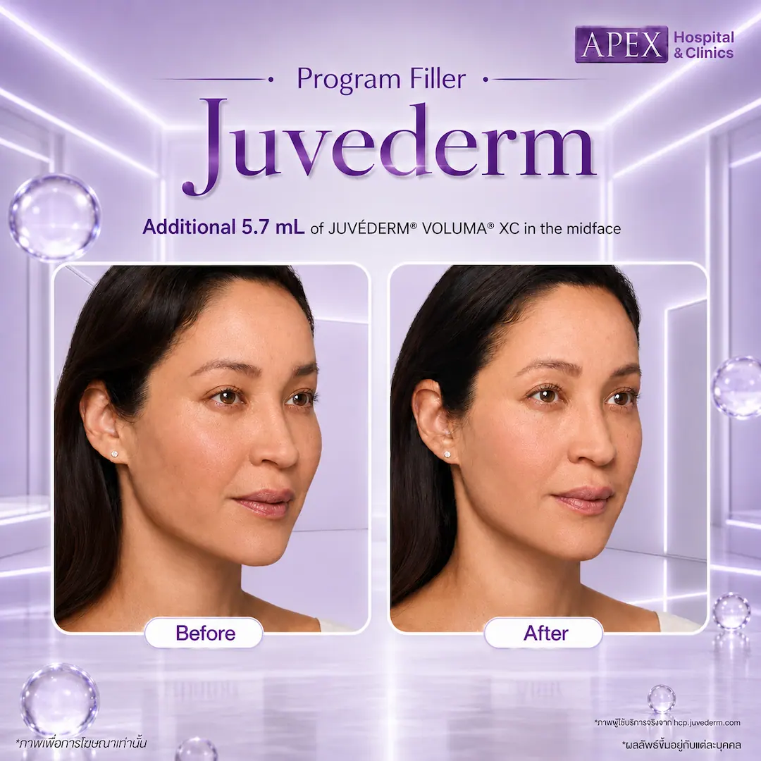 รีวิว ฟิลเลอร์ Juvederm