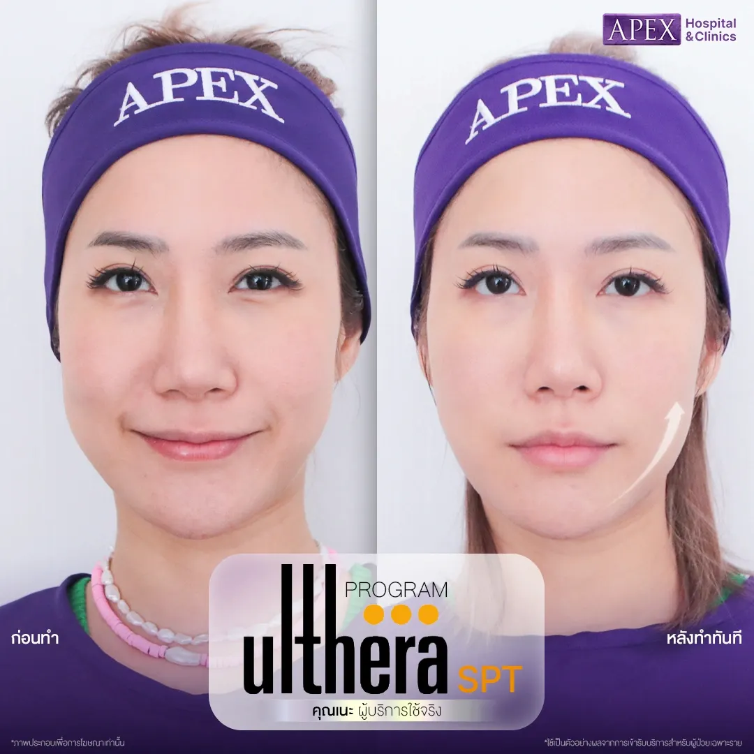 รีวิว Ulthera SPT