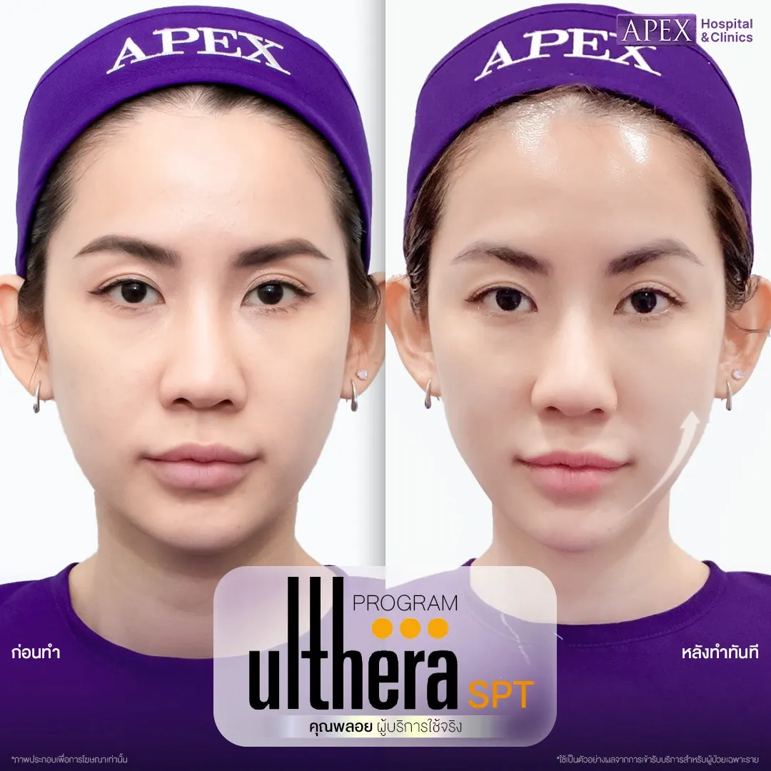 รีวิว Ulthera SPT