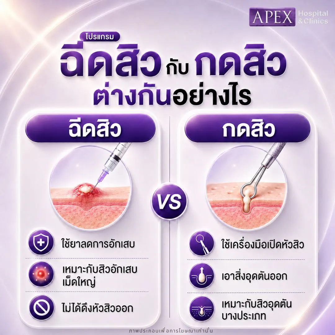 ฉีดสิวกับกดสิวต่างกันอย่างไร