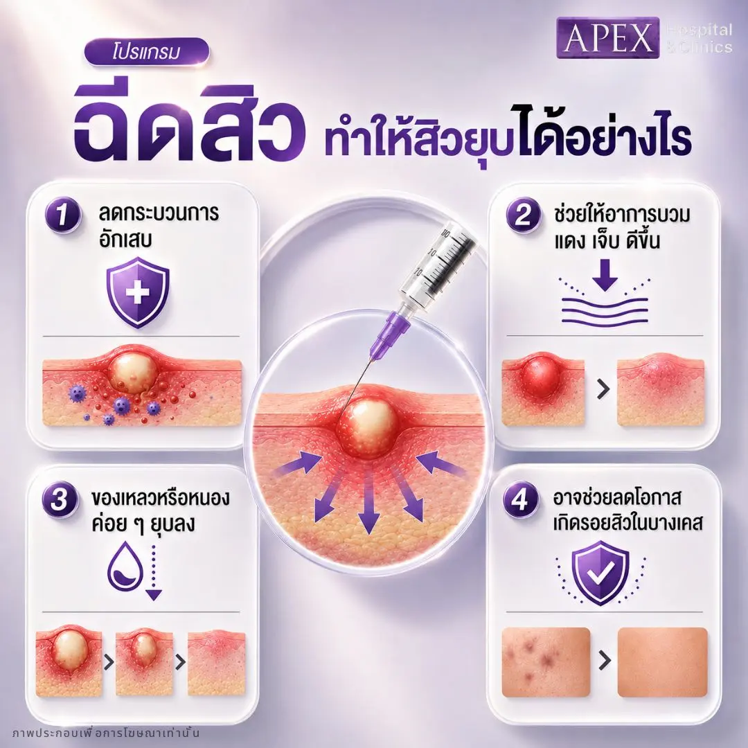 ฉีดสิวทำให้สิวยุบได้อย่างไร