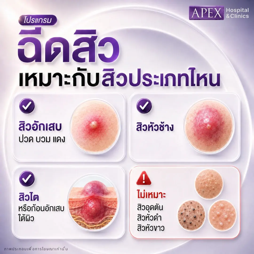 ฉีดสิวเหมาะกับสิวประเภทไหนบ้าง