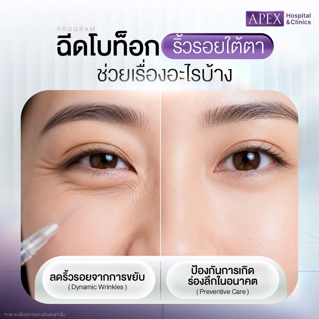 ฉีดโบท็อกริ้วรอยใต้ตา ช่วยอะไร ฉีดจุดไหนได้บ้าง