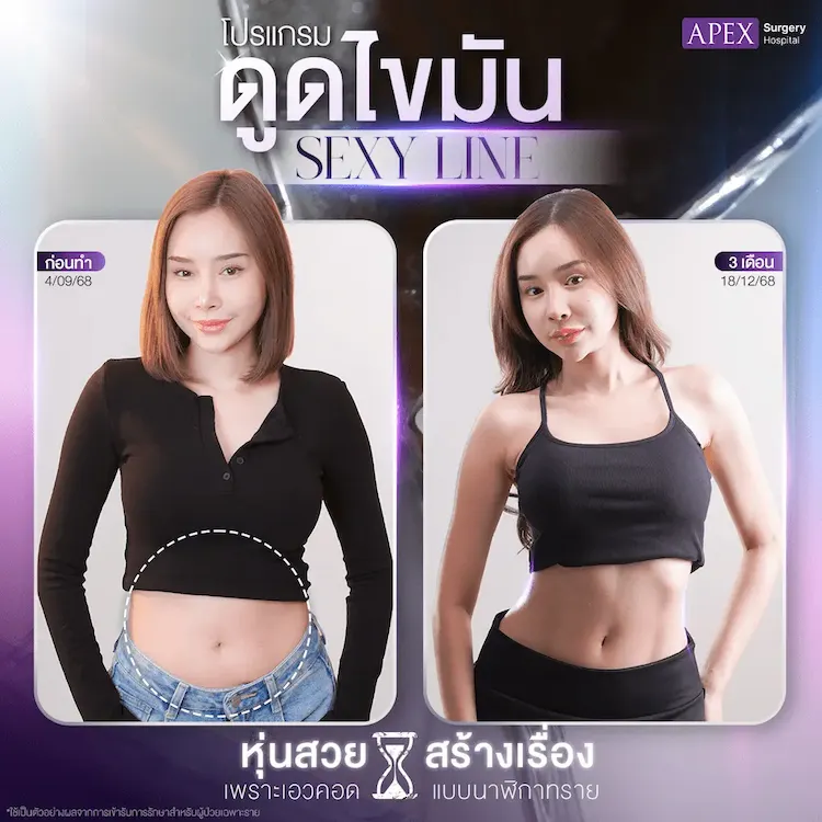 รีวิว ดูดไขมัน