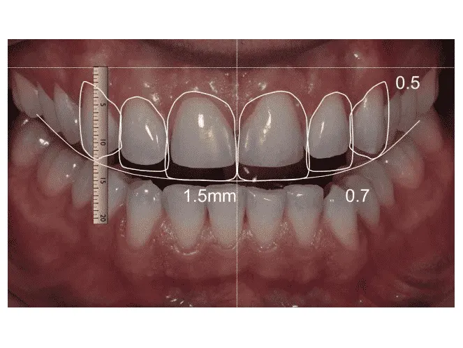 ทำวีเนียร์