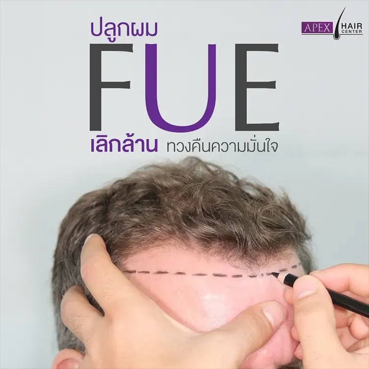 ปลูกผม FUE