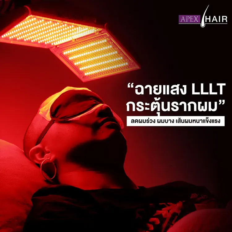 ปลูกผมด้วยแสงเลเซอร์ LLLT