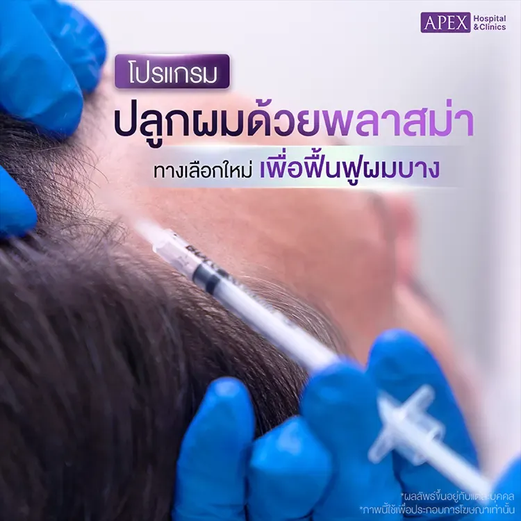 ปลูกผมพลาสม่า PRP