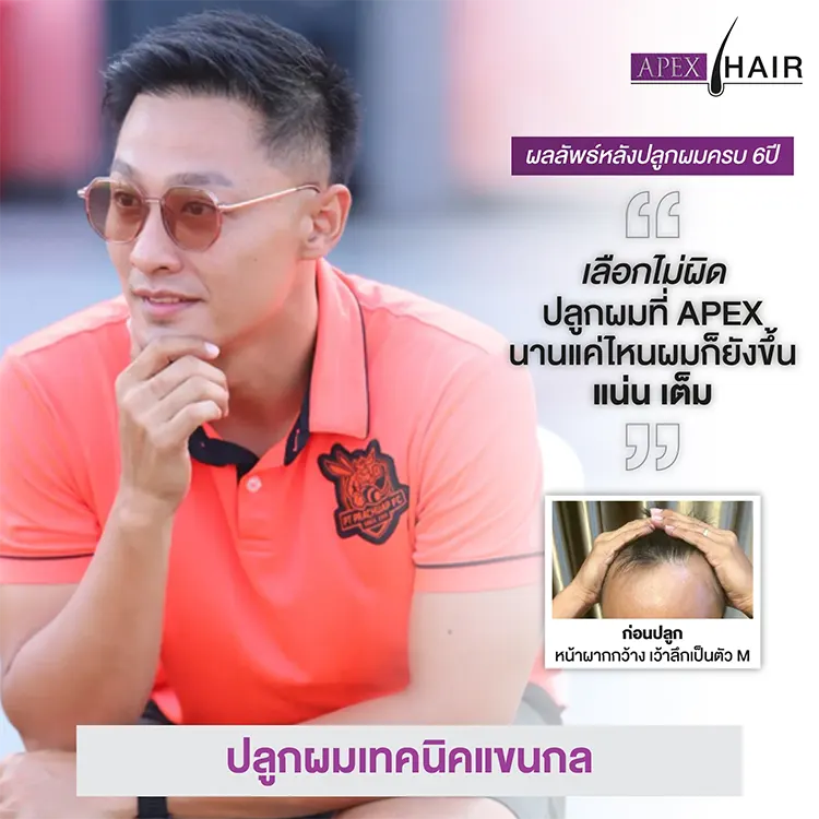 ปลูกผมเทคนิคแขนกล กี่เดือนถึงจะเห็นผลลัพธ์