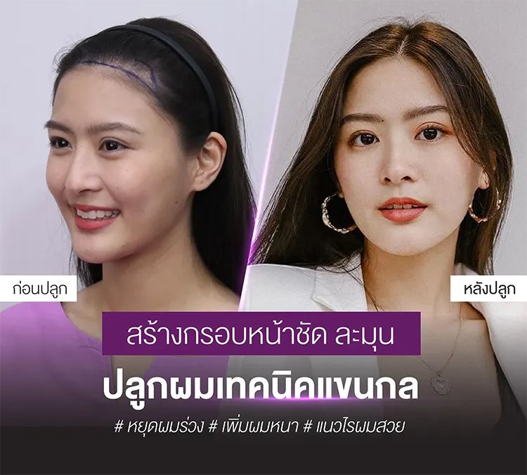 ปลูกผมเทคนิคแขนกล ต้องใช้กี่กราฟต์