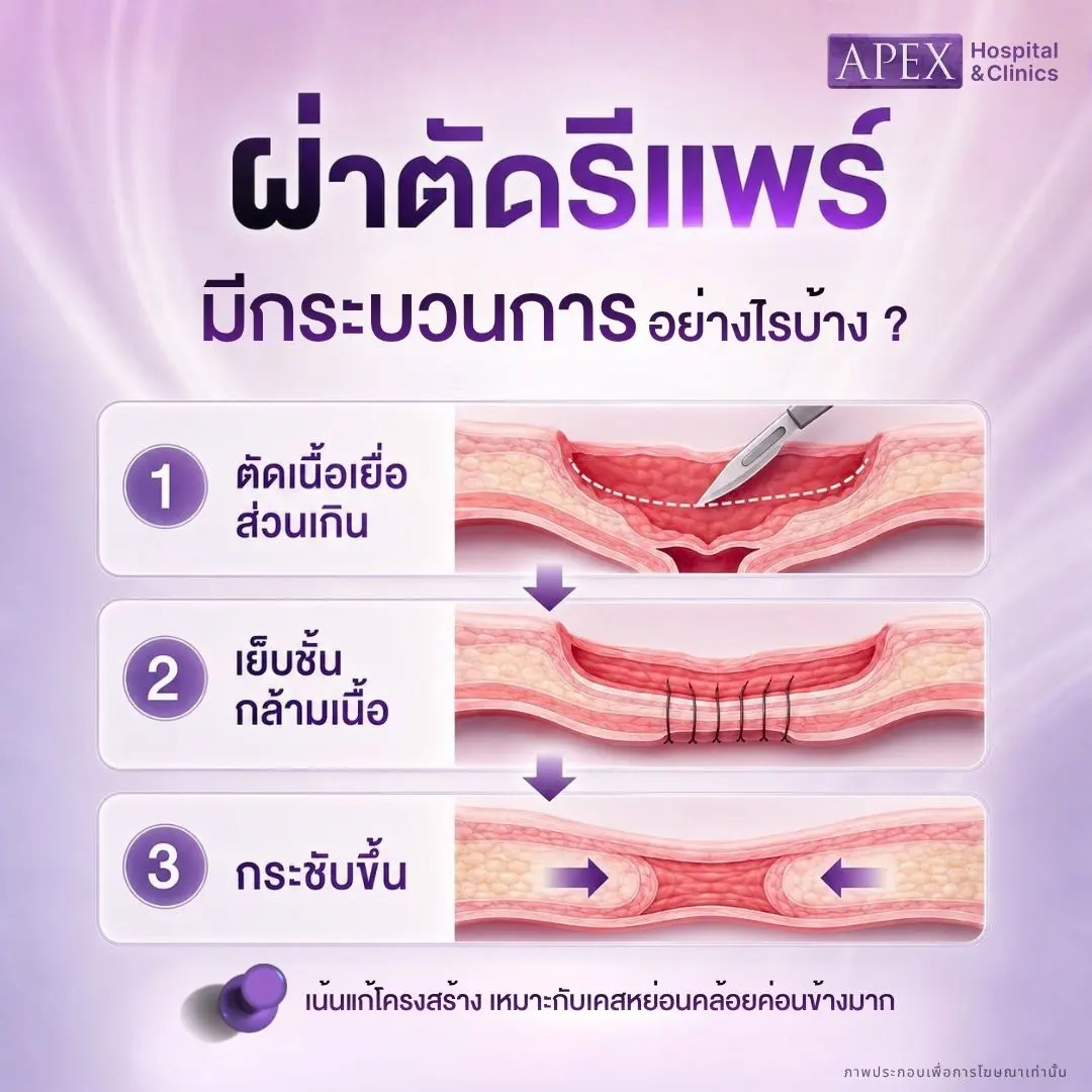 ผ่าตัดรีแพร์