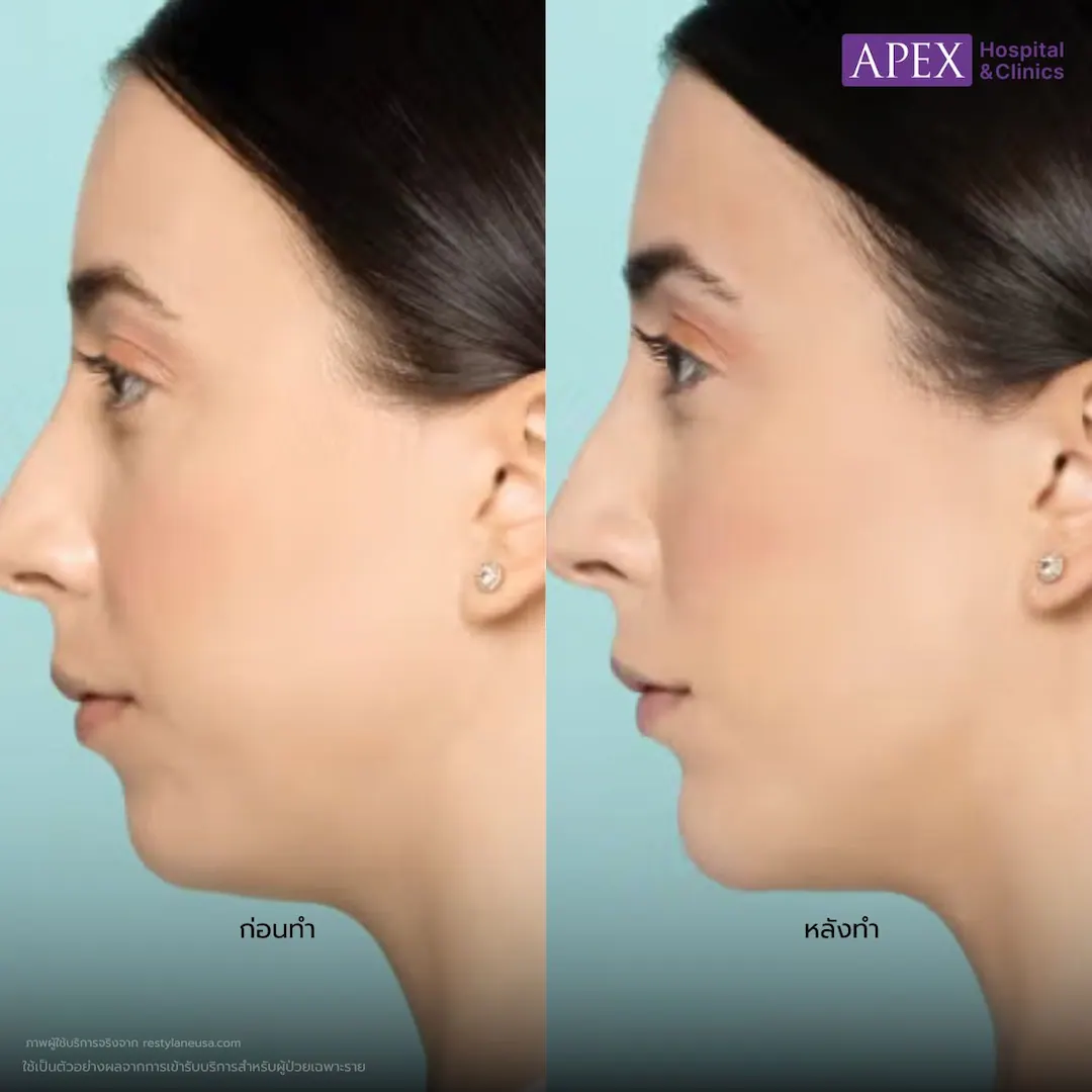 รีวิว ฟิลเลอร์ Restylane