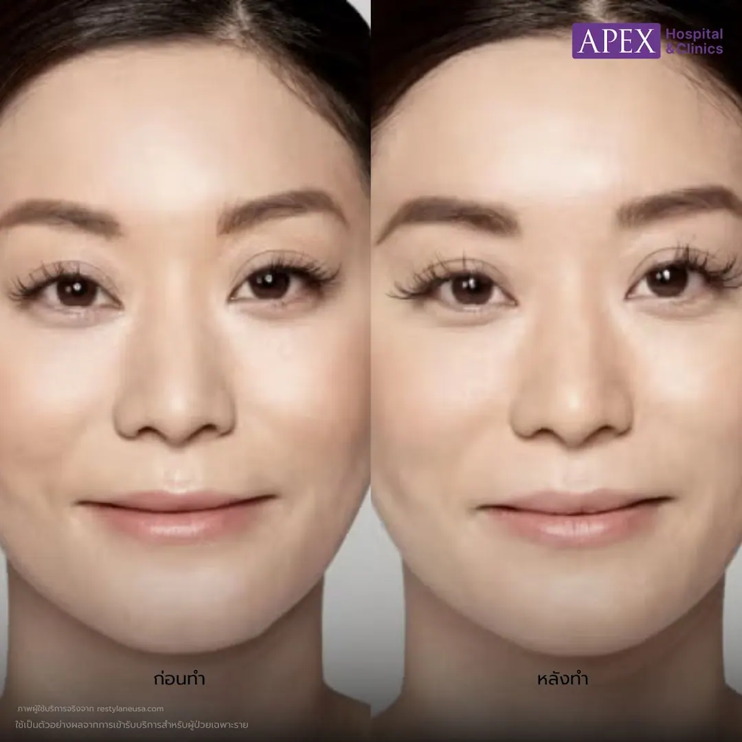 รีวิว ฟิลเลอร์ Restylane