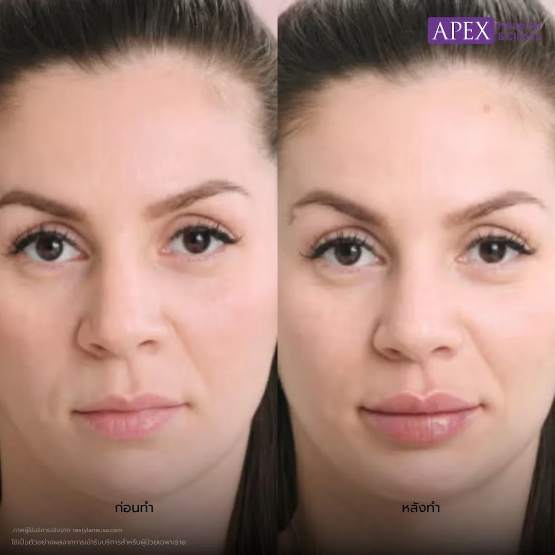 รีวิว ฟิลเลอร์ Restylane
