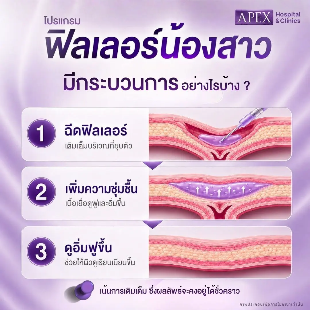 ฟิลเลอร์น้องสาว