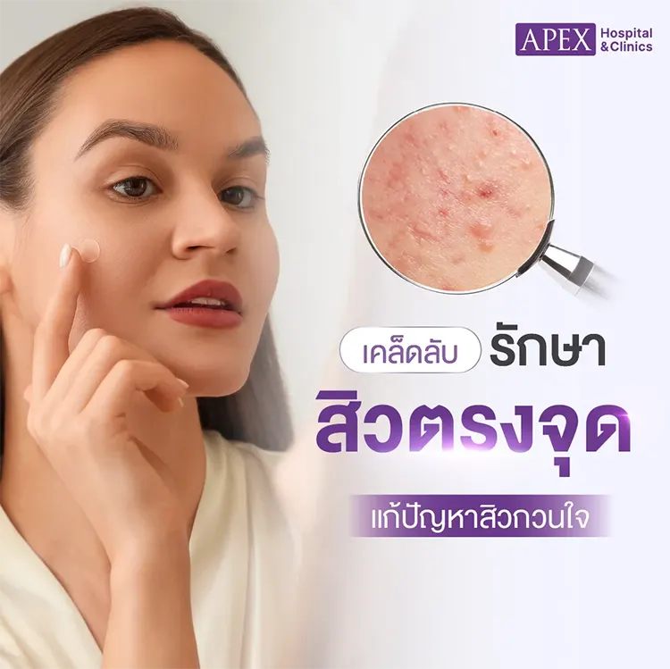 รักษาสิว