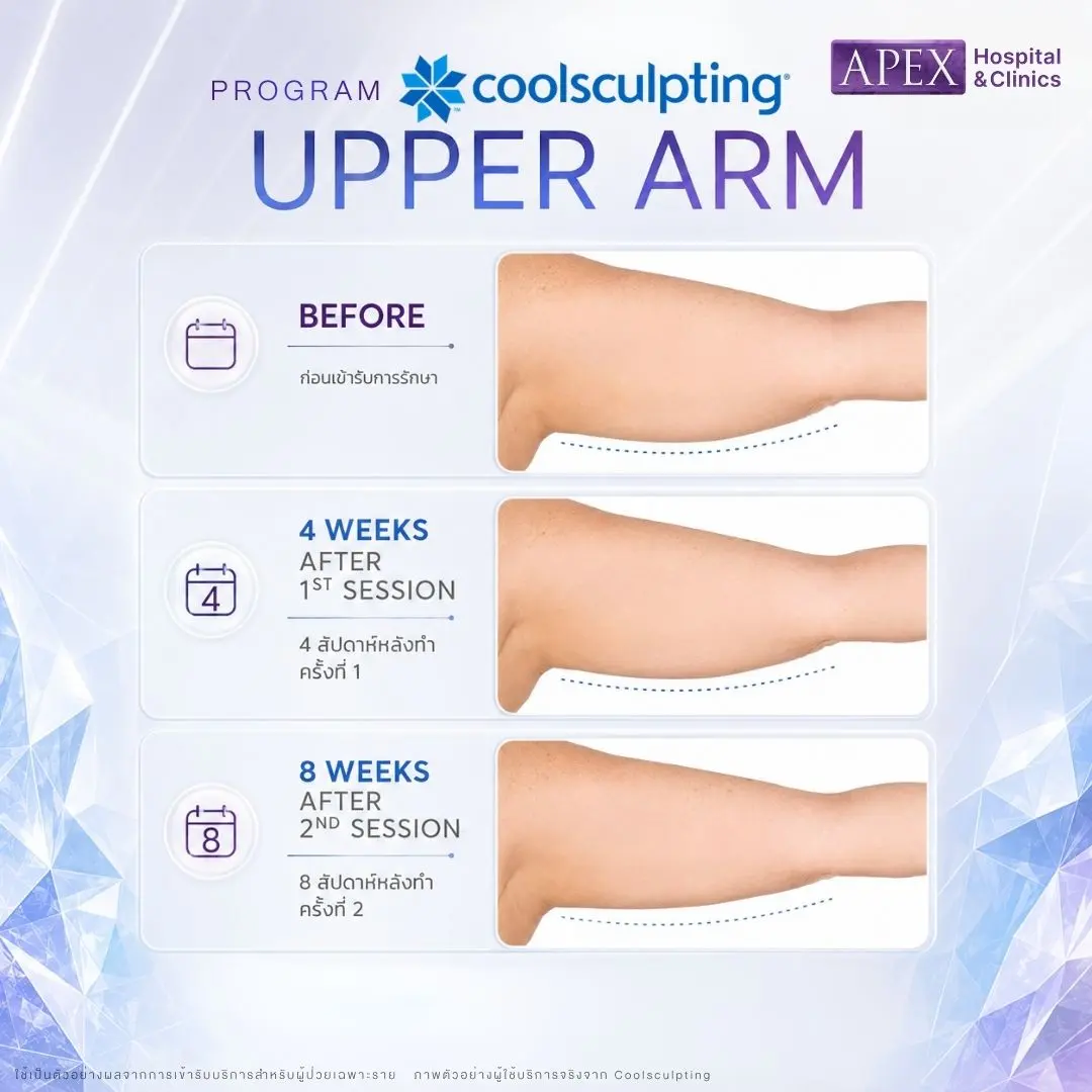 รีวิว Coolsculpting