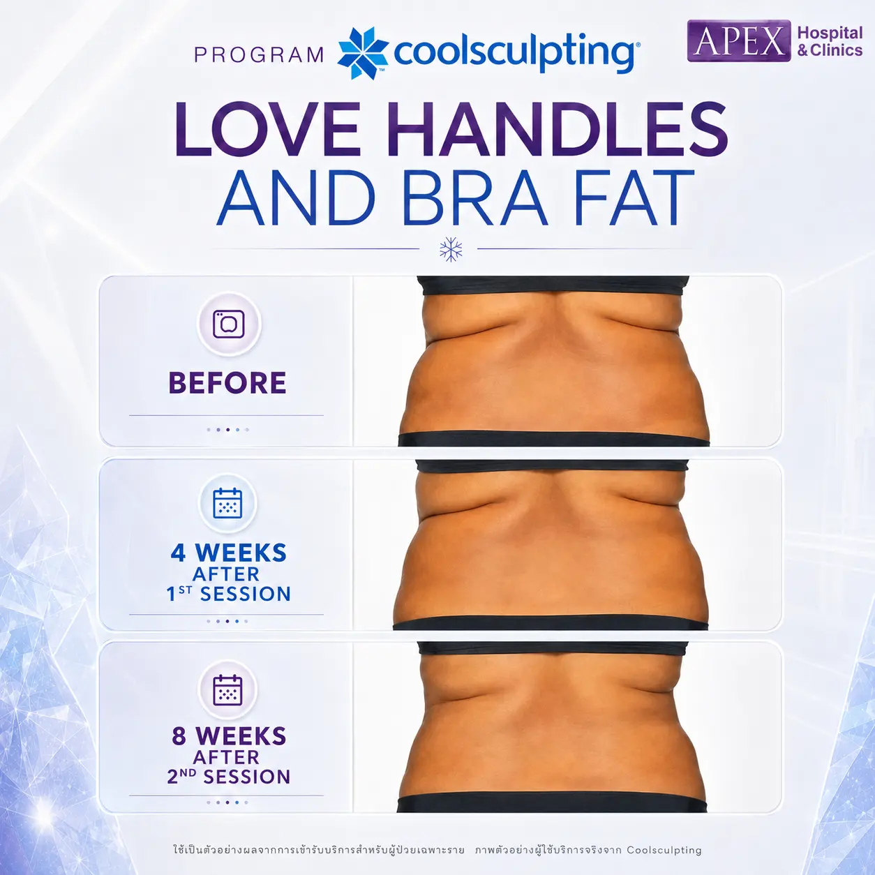 รีวิว Coolsculpting
