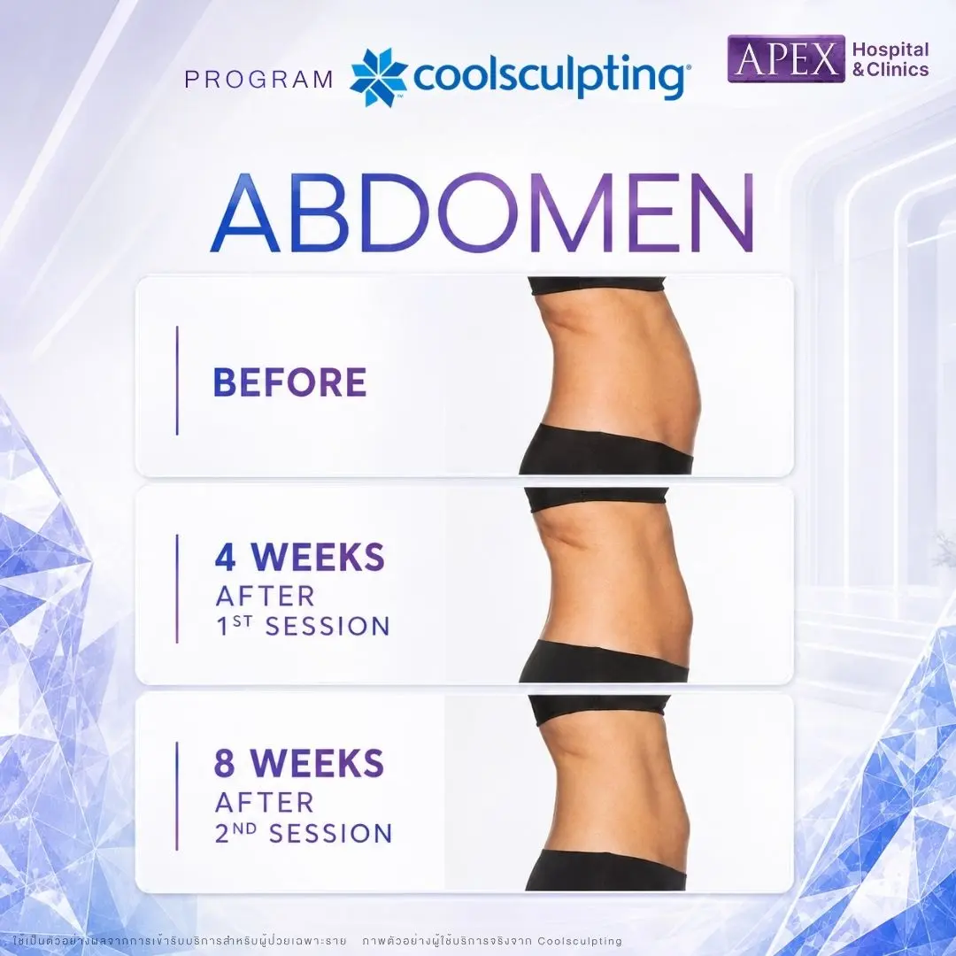 รีวิว Coolsculpting