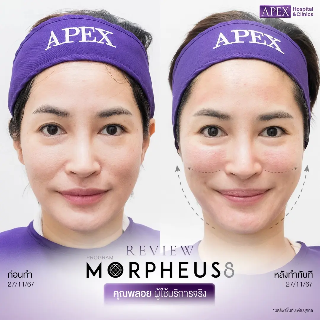 รีวิว Morpheus8