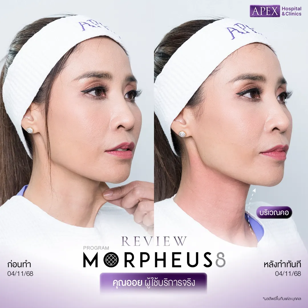 รีวิว Morpheus8