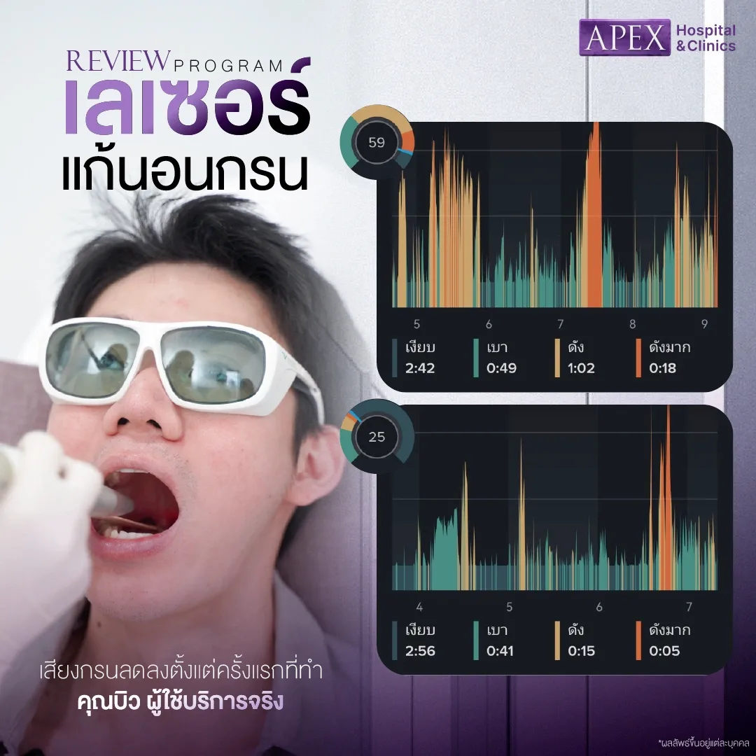 รีวิวหลังทำเลเซอร์นอนกรน