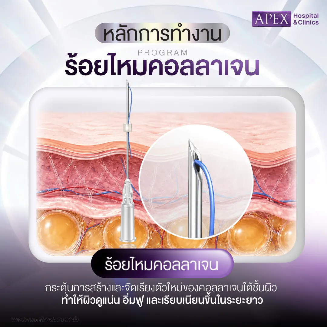ร้อยไหมคอลลาเจน ทำงานอย่างไร