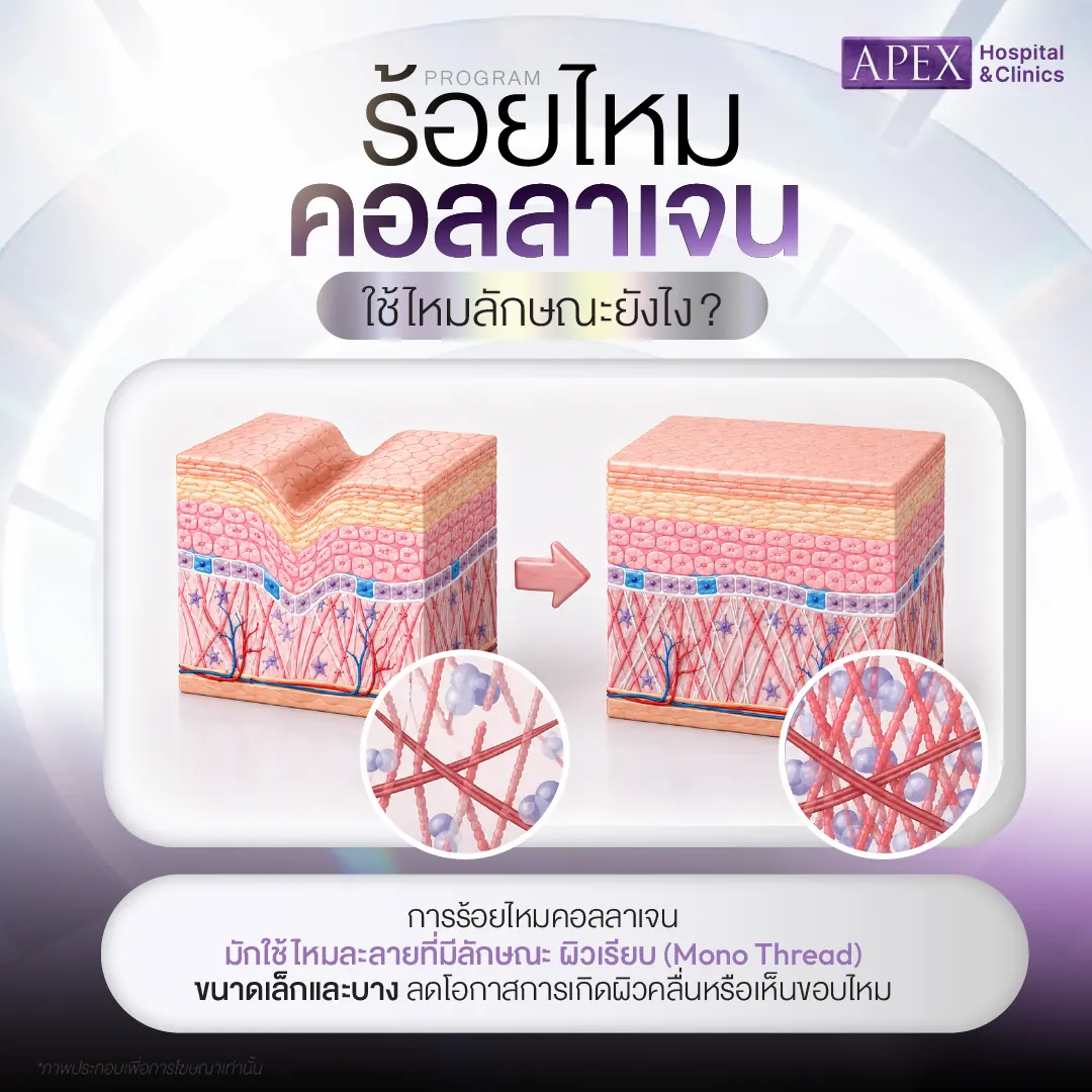 ร้อยไหมคอลลาเจนใช้ไหมลักษณะใด