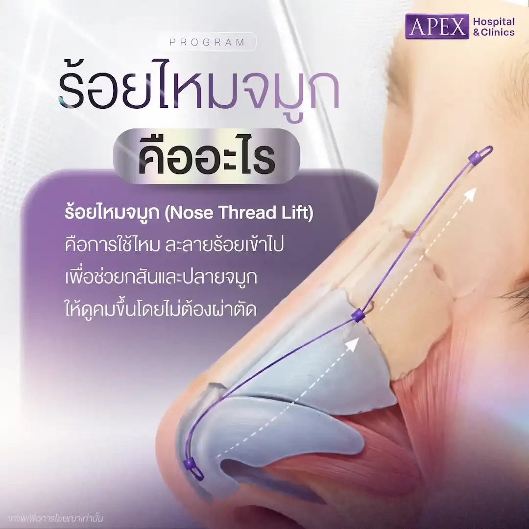 ร้อยไหมจมูก คืออะไร