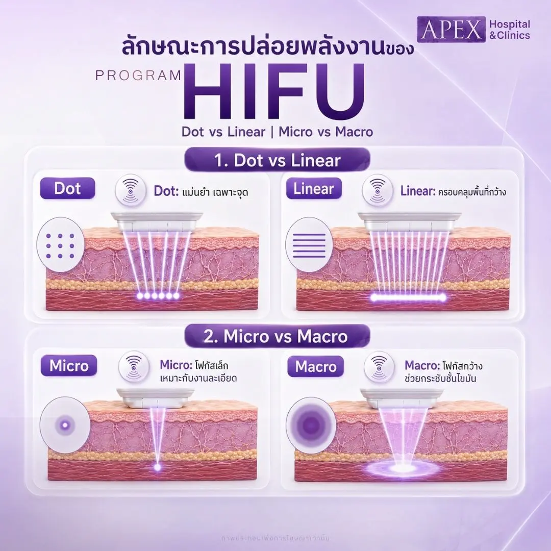 ลักษณะการปล่อยพลังงานของเครื่อง HIFU