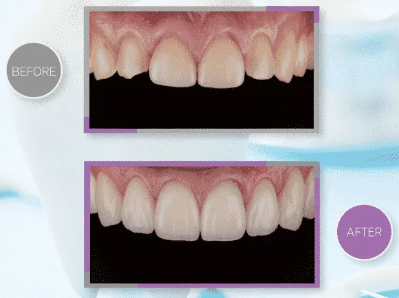 วีเนียร์เหมาะกับใคร